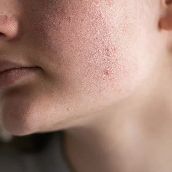 What is Sensitive Skin?