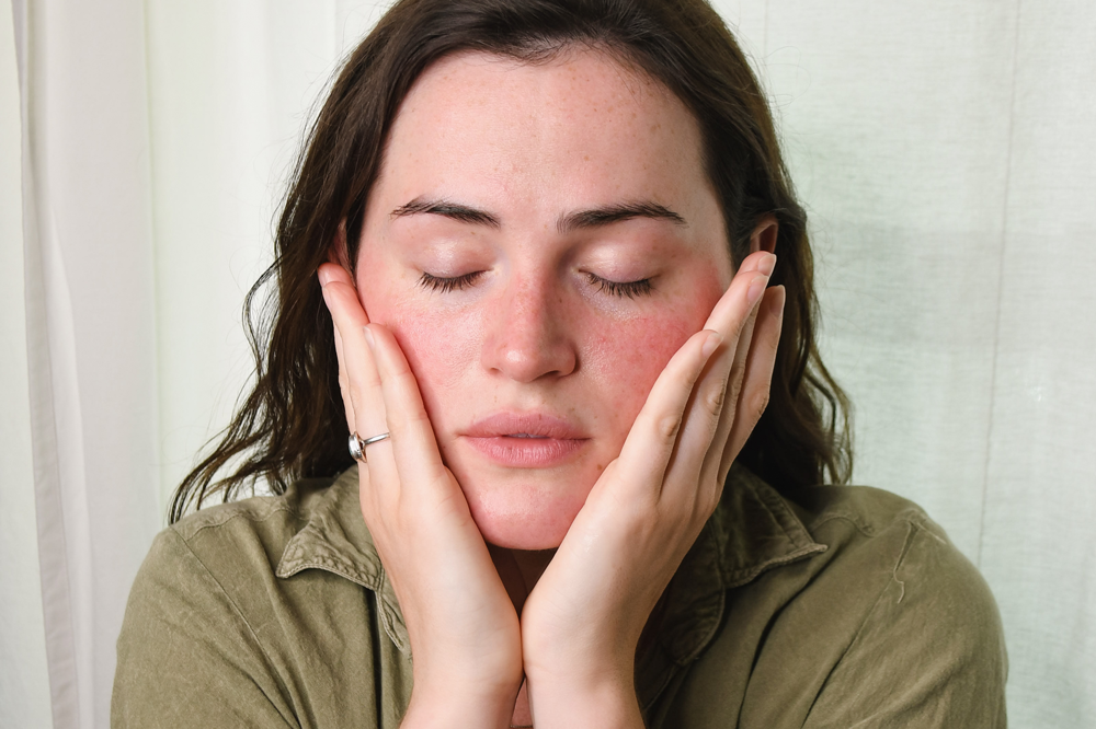 Woman with red, inflamed skin trying to soothe face with her hands