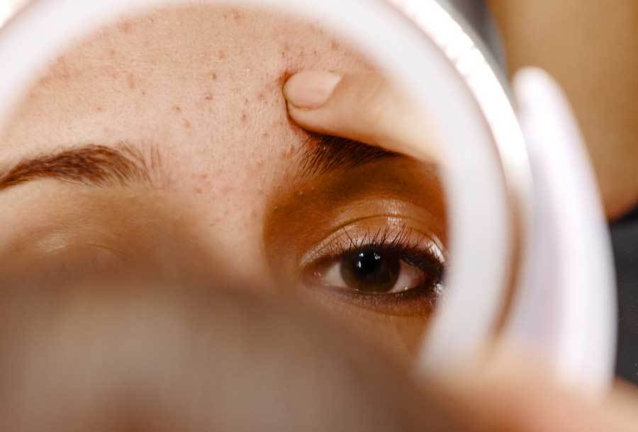Woman looking at acne on forehead.