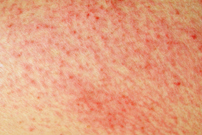 Tackling Annoying, but Common, Skin Issues