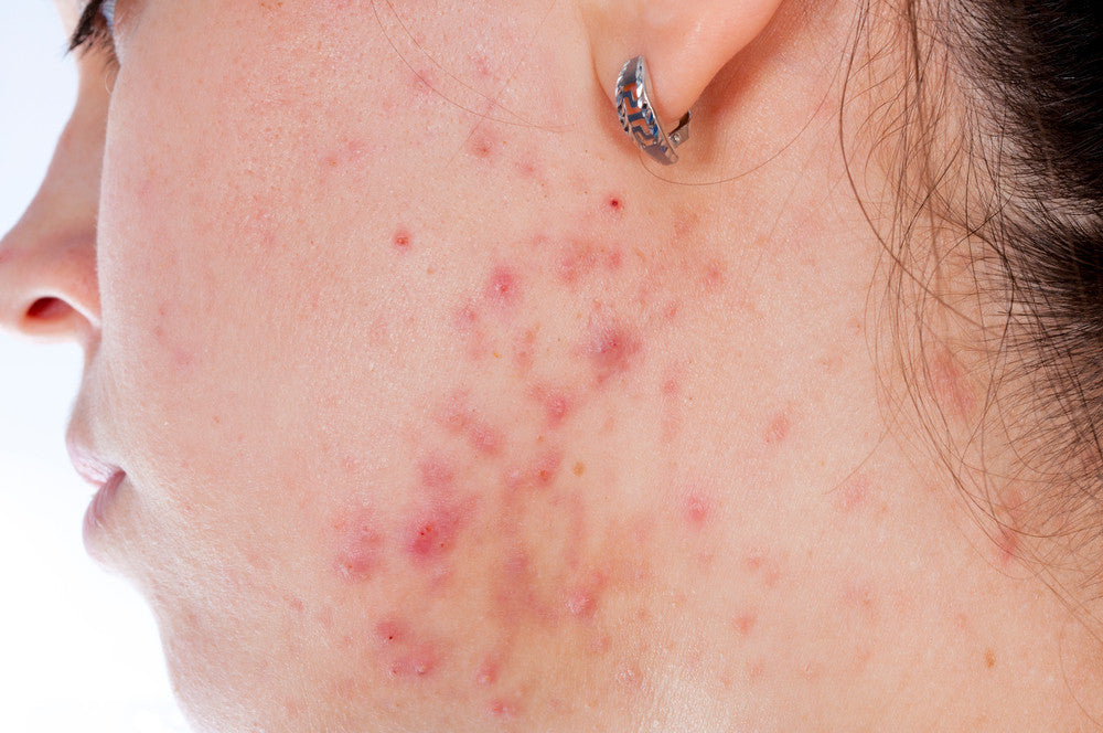 Top 9 Ways to Prevent Acne Breakouts (from Guest Blogger Samantha Pope-Cubillos)
